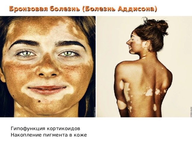 Бронзовая болезнь (Болезнь Аддисона) Гипофункция кортикоидов Накопление пигмента в коже 