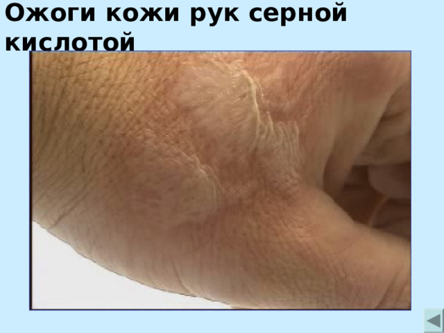 Ожоги кожи рук серной кислотой 