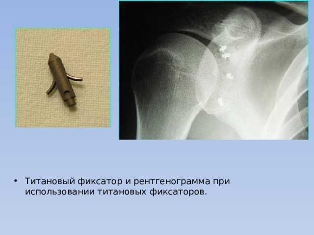 Титановый фиксатор и рентгенограмма при использовании титановых фиксаторов. 