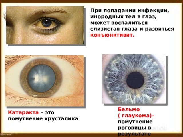 При попадании инфекции, инородных тел в глаз, может воспалиться слизистая глаза и развиться конъюнктивит . Бельмо ( глаукома)– помутнение роговицы в результате травмы. Катаракта – это помутнение хрусталика 