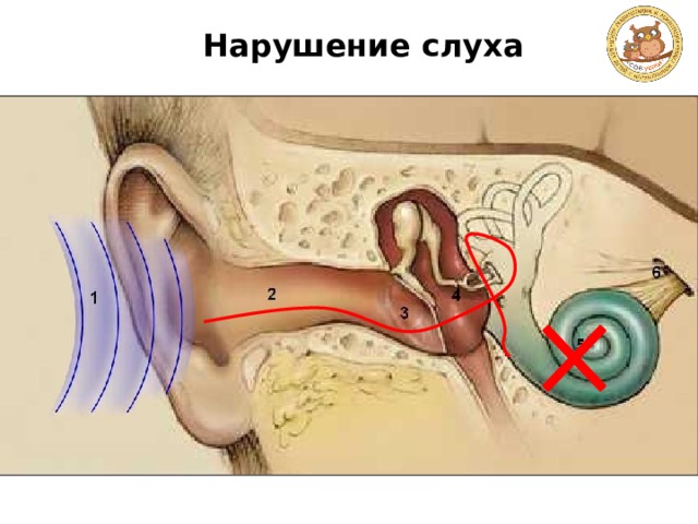 Нарушение слуха 