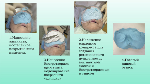 1.Нанесение альгината, постепенное покрытие лица пациента. 2.Наложение марлевого компресса для создания ретенционного пункта между альгинатной массой и быстротвердеющим гипсом 3.Нанесение быстротвердеющего гипса, моделирование покровного «колпака» 4.Готовый лицевой оттиск 