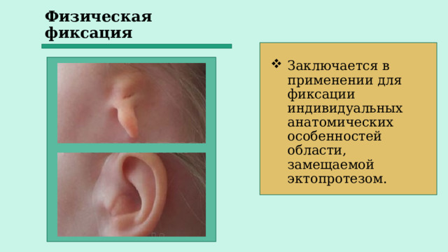 Физическая фиксация Заключается в применении для фиксации индивидуальных анатомических особенностей области, замещаемой эктопротезом. 