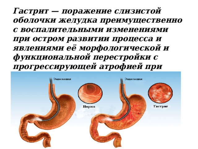 Гастрит — поражение слизистой оболочки желудка преимущественно с воспалительными изменениями при остром развитии процесса и явлениями её морфологической и функциональной перестройки с прогрессирующей атрофией при хроническом течении. 