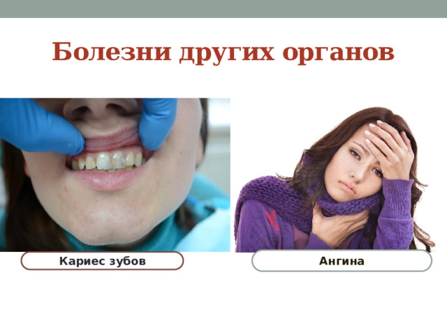 Болезни других органов Ангина Кариес зубов 