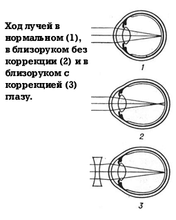 На рисунке 10 приведены схемы хода лучей в глазе при близорукости