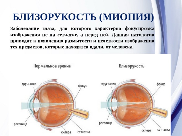 У близоруких людей изображение фокусируется перед сетчаткой. Заболевание миопия. Близорукость сетчатка. Болезнь глаз близорукость.