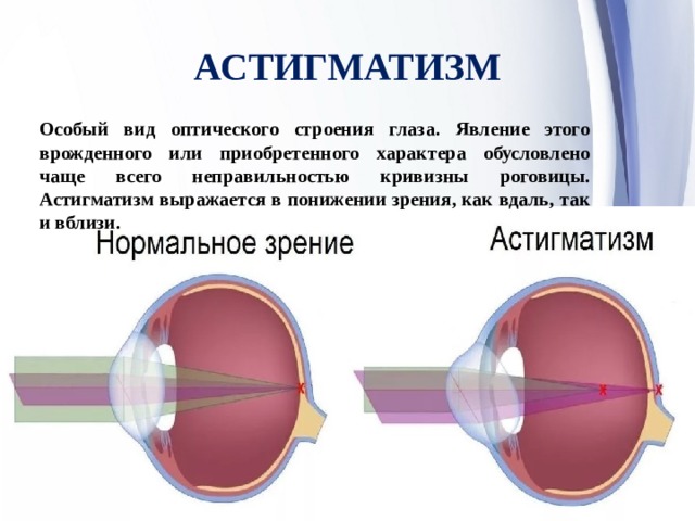 Астигматизм это простыми словами