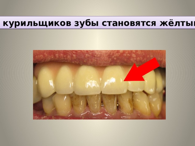 У курильщиков зубы становятся жёлтыми 