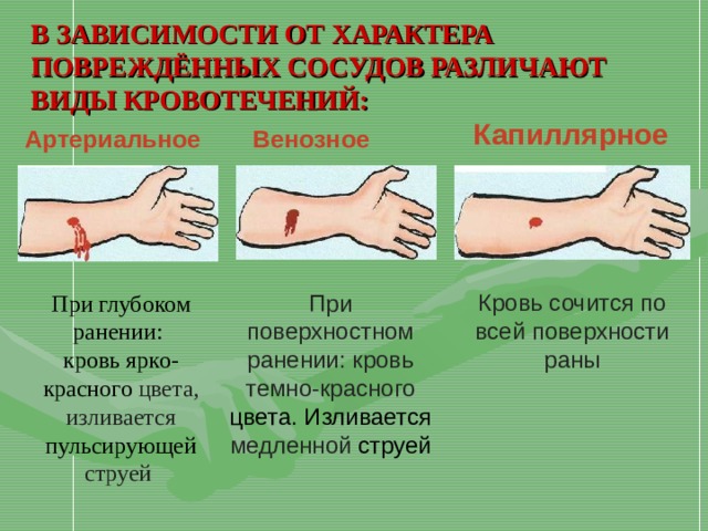 В ЗАВИСИМОСТИ ОТ ХАРАКТЕРА ПОВРЕЖДЁННЫХ СОСУДОВ РАЗЛИЧАЮТ ВИДЫ КРОВОТЕЧЕНИЙ: Капиллярное  Артериальное  Венозное  Кровь сочится по всей поверхности раны При поверхностном ранении: кровь темно-красного цвета. Изливается медленной струей При глубоком ранении: к ровь ярко-красного цвета , и зливается пульсирующей струей  