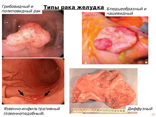 Типы рака желудка Грибовидный и полиповидный рак Блюдцеобразный и чашевидный Язвенно-инфильтративный (язвенноподобный ). Диффузный (7) 