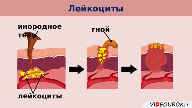 Лейкоциты инородное тело гной лейкоциты 