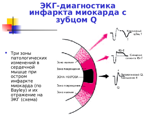 Диагностика ишемии. Зоны инфаркта на ЭКГ. Стадии инфаркта на ЭКГ. Фазы инфаркта на ЭКГ. Инфаркт диагностика ЭКГ.