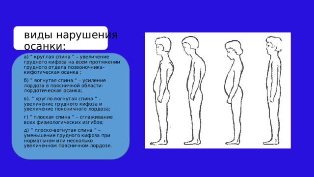 Круглая спина в год. Лордотическая и кифотическая осанка. Кругло вогнутая осанка. Плоско вогнутая осанка. Круглая спина.