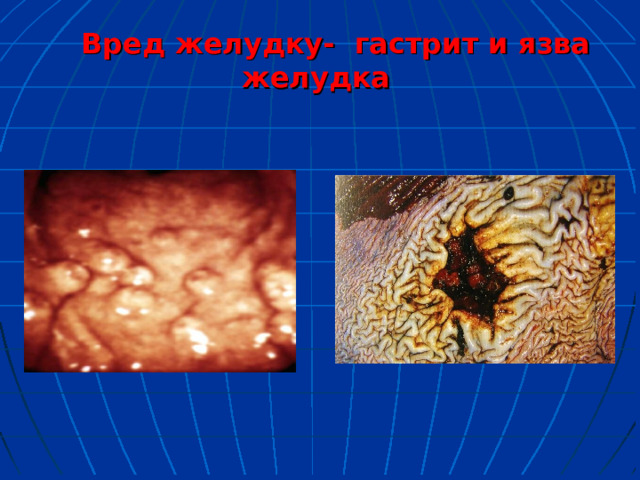  Вред желудку- гастрит и язва желудка 