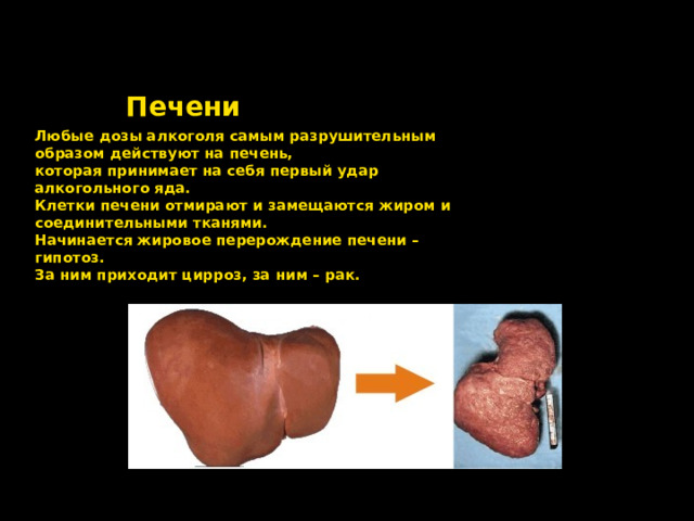 Печени Любые дозы алкоголя самым разрушительным образом действуют на печень, которая принимает на себя первый удар алкогольного яда. Клетки печени отмирают и замещаются жиром и соединительными тканями. Начинается жировое перерождение печени – гипотоз. За ним приходит ц и рроз, за ним – рак. 