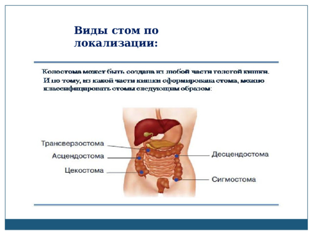 Где стом. Виды стом по локализации.