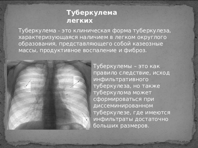 Туберкулема легких Туберкулема - это клиническая форма туберкулеза, характеризующаяся наличием в легком округлого образования, представляющего собой казеозные массы, продуктивное воспаление и фиброз. Туберкулемы – это как правило следствие, исход инфильтративного туберкулеза, но также туберкулома может сформироваться при диссеминированном туберкулезе, где имеются инфильтраты достаточно больших размеров. 