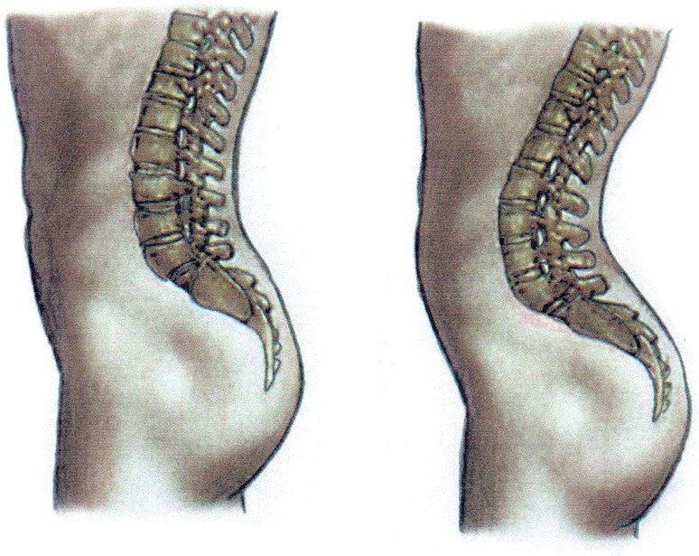 Позвоночник вперед. Лордоз поясничного отдела позвоночника. Изгибы позвоночника вперед (лордоз)______,. Что такое лордоз позвоночника поясничного. Лордоз поясничного отдела позвоночника причины.