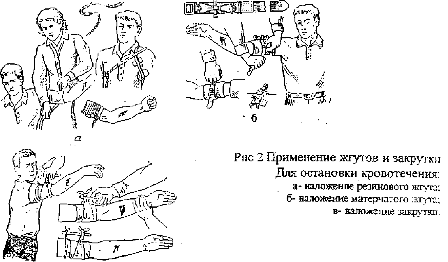 Когда накладывают шину на конечности. Матерчатый жгут закрутка. Жгут закрутка при артериальном кровотечении. Наложение шины при переломе. Акушерский травматизм методичка.