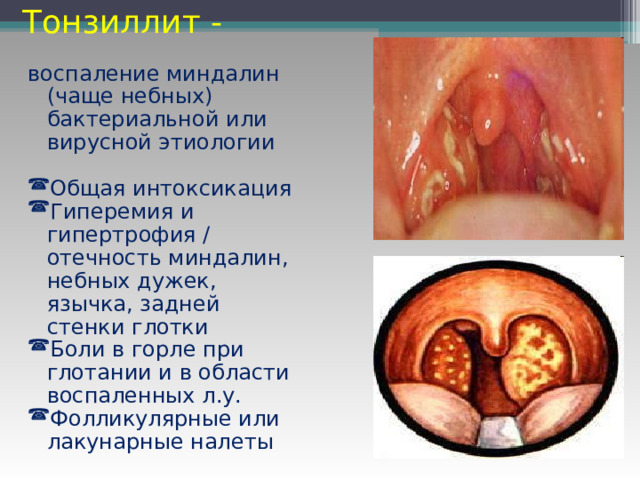 Тонзиллит - воспаление миндалин (чаще небных) бактериальной или вирусной этиологии Общая интоксикация Гиперемия и гипертрофия / отечность миндалин, небных дужек, язычка, задней стенки глотки Боли в горле при глотании и в области воспаленных л.у. Фолликулярные или лакунарные налеты 