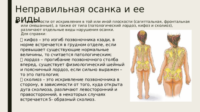 Неправильная осанка и ее виды В зависимости от искривления в той или иной плоскости (сагиттальная, фронтальная или смешанные), а также от типа (патологический лордоз, кифоз и сколиоз), различают отдельные виды нарушения осанки.  Для справки:    кифоз – это изгиб позвоночника кзади, в норме встречается в грудном отделе, если превышает существующие нормальные величины, то считается патологическим;   лордоз – прогибание позвоночного столба вперед, существует физиологический шейный и поясничный лордоз, если сильно выражен – то это патология;   сколиоз – это искривление позвоночника в сторону, в зависимости от того, куда открыта дуга сколиоза, различают левосторонний и правосторонний, в некоторых случаях встречается S- образный сколиоз.   