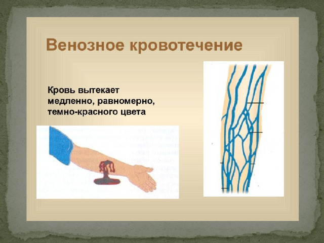Из приведенных примеров выберите характеризующие венозные кровотечения