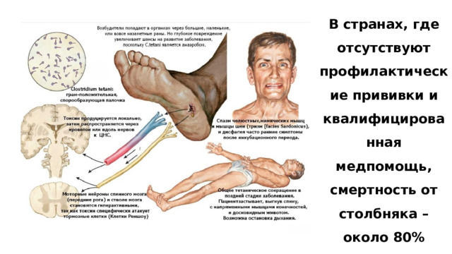 В странах, где отсутствуют профилактические прививки и квалифицированная медпомощь, смертность от столбняка – около 80% 