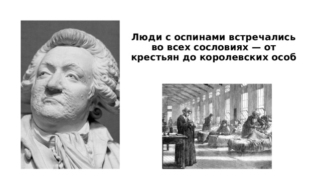 Люди с оспинами встречались во всех сословиях — от крестьян до королевских особ 