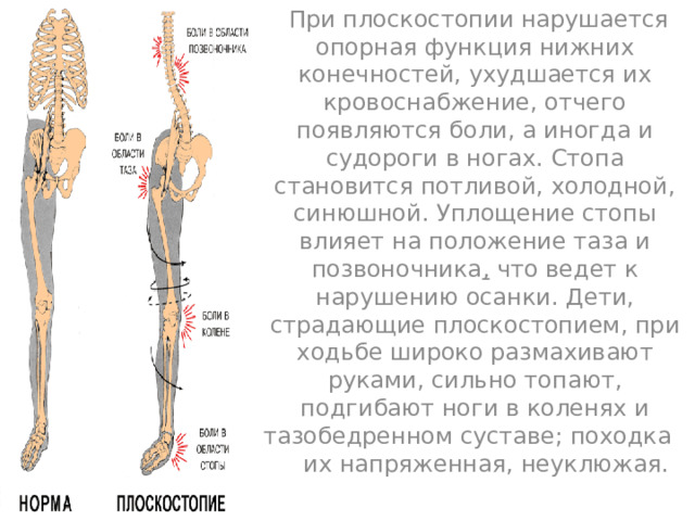 Продольное плоскостопие мкб