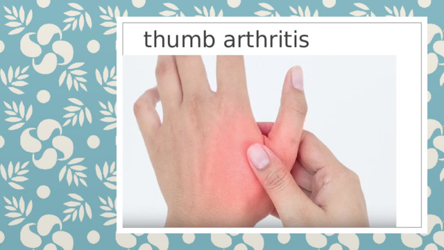 thumb arthritis 