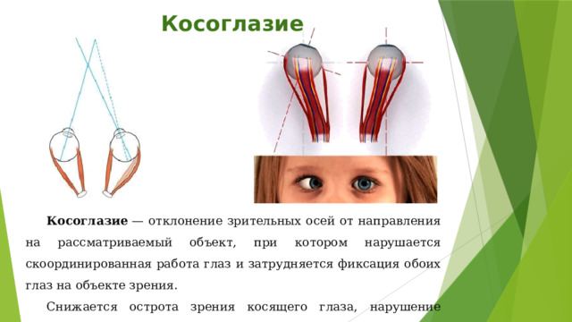 Косоглазие Косоглазие  — отклонение зрительных осей от направления на рассматриваемый объект, при котором нарушается скоординированная работа глаз и затрудняется фиксация обоих глаз на объекте зрения. Снижается острота зрения косящего глаза, нарушение бинокулярного зрения. 