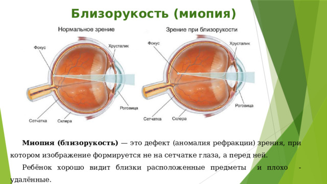 Глаз биология 8 класс кратко. Заболевания глаз презентация 8 класс. Близорукий. Как видят при миопии и -8.