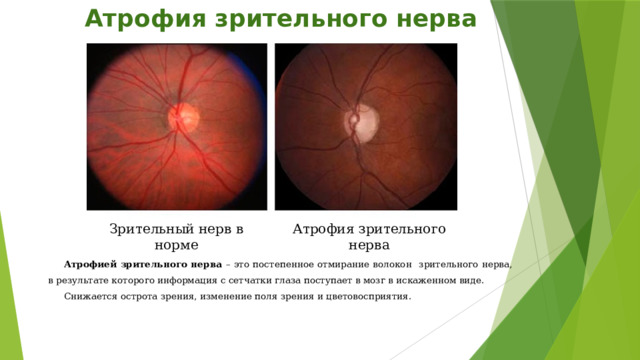 Атрофия зрительного нерва Зрительный нерв в норме Атрофия зрительного нерва Атрофией зрительного нерва – это постепенное отмирание волокон зрительного нерва, в результате которого информация с сетчатки глаза поступает в мозг в искаженном виде. Снижается острота зрения, изменение поля зрения и цветовосприятия. 