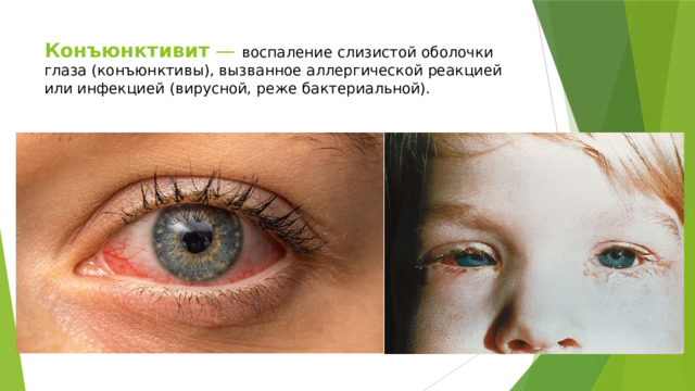 Конъюнктивит — воспаление слизистой оболочки глаза (конъюнктивы), вызванное аллергической реакцией или инфекцией (вирусной, реже бактериальной). 