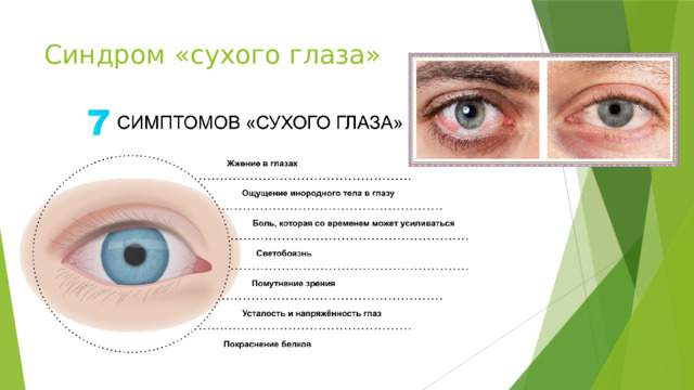 Синдром «сухого глаза» 