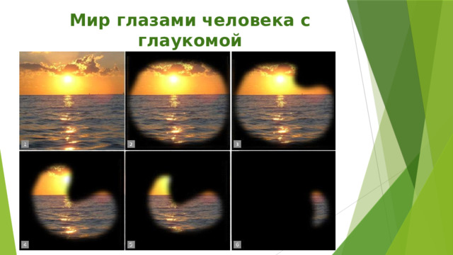 Мир глазами человека с глаукомой  (разные стадии) 