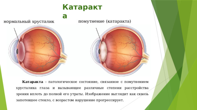 Катаракта помутнение (катаракта) нормальный хрусталик Катаракта – патологическое состояние, связанное с помутнением хрусталика глаза и вызывающее различные степени расстройства зрения вплоть до полной его утраты. Изображение выглядит как сквозь запотевшее стекло, с возрастом нарушение прогрессирует.  