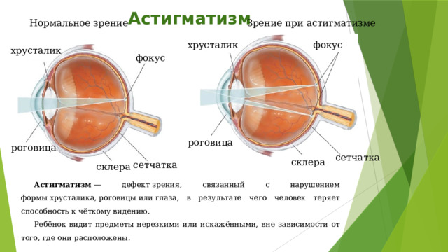 Астигматизм Зрение при астигматизме Нормальное зрение хрусталик фокус хрусталик фокус роговица роговица сетчатка склера сетчатка склера Астигматизм  — дефект зрения, связанный с нарушением формы хрусталика, роговицы или глаза, в результате чего человек теряет способность к чёткому видению. Ребёнок видит предметы нерезкими или искажёнными, вне зависимости от того, где они расположены. 