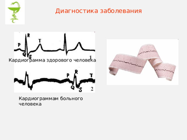 Диагностика заболевания Кардиограмма здорового человека Кардиограммам больного человека 