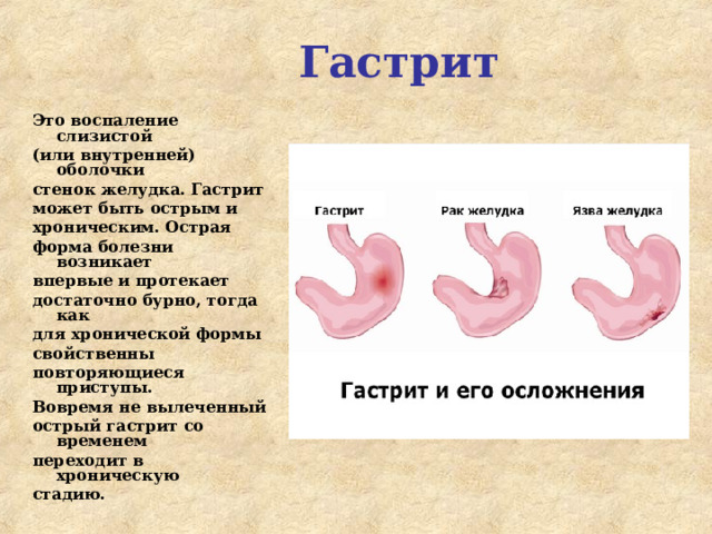 Гастрит Это воспаление слизистой (или внутренней) оболочки стенок желудка. Гастрит может быть острым и хроническим. Острая форма болезни возникает впервые и протекает достаточно бурно, тогда как для хронической формы свойственны повторяющиеся приступы. Вовремя не вылеченный острый гастрит со временем переходит в хроническую стадию.  