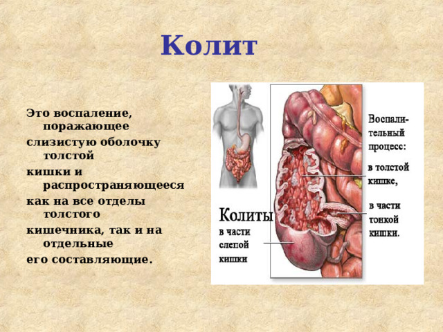 Колит Это воспаление, поражающее слизистую оболочку толстой кишки и распространяющееся как на все отделы толстого кишечника, так и на отдельные его составляющие. 