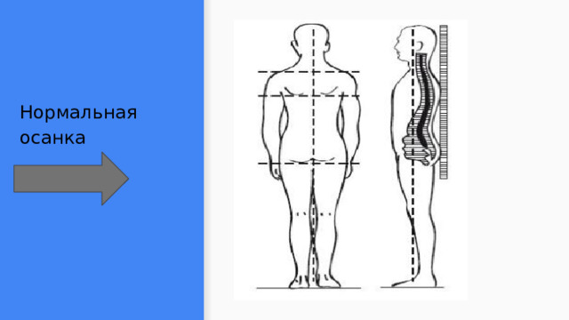 Рассмотрите рисунки 1 4 на каком из них изображен подросток с нормальной осанкой