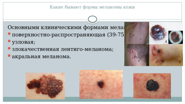 Какие бывают формы меланомы кожи   Основными клиническими формами меланомы являются: поверхностно-распространяющая (39-75 %); узловая; злокачественная лентиго-меланома; акральная меланома. 