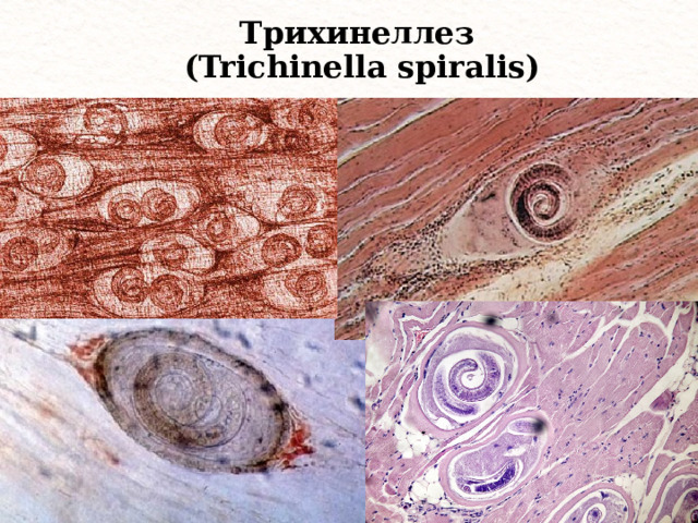 Трихинеллез  (Trichinella spiralis) 