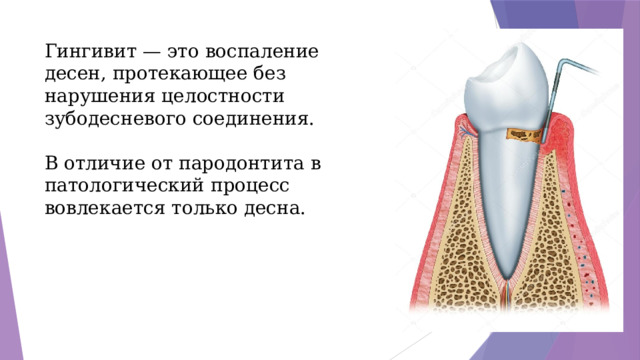 Гингивит — это воспаление десен, протекающее без нарушения целостности зубодесневого соединения. В отличие от пародонтита в патологический процесс вовлекается только десна.  