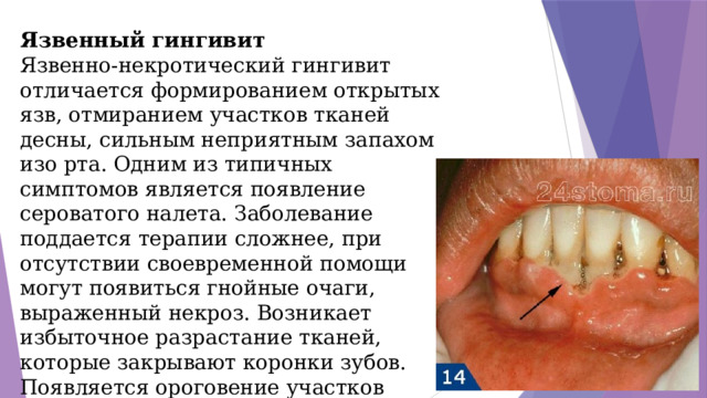 Язвенный гингивит Язвенно-некротический гингивит отличается формированием открытых язв, отмиранием участков тканей десны, сильным неприятным запахом изо рта. Одним из типичных симптомов является появление сероватого налета. Заболевание поддается терапии сложнее, при отсутствии своевременной помощи могут появиться гнойные очаги, выраженный некроз. Возникает избыточное разрастание тканей, которые закрывают коронки зубов. Появляется ороговение участков десны.  