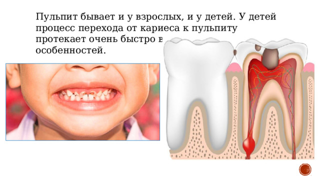 Пульпит бывает и у взрослых, и у детей. У детей процесс перехода от кариеса к пульпиту протекает очень быстро ввиду физиологических особенностей. 