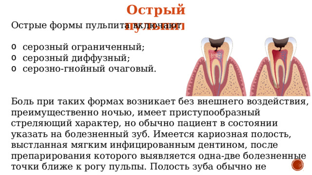 Острый пульпит Острые формы пульпита включают в себя: серозный ограниченный; серозный диффузный; серозно-гнойный очаговый. Боль при таких формах возникает без внешнего воздействия, преимущественно ночью, имеет приступообразный стреляющий характер, но обычно пациент в состоянии указать на болезненный зуб. Имеется кариозная полость, выстланная мягким инфицированным дентином, после препарирования которого выявляется одна-две болезненные точки ближе к рогу пульпы. Полость зуба обычно не вскрыта. 