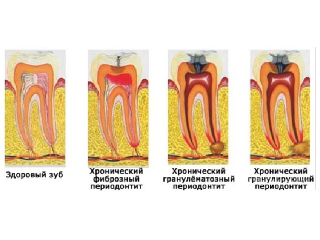 Хронические формы пульпита презентация